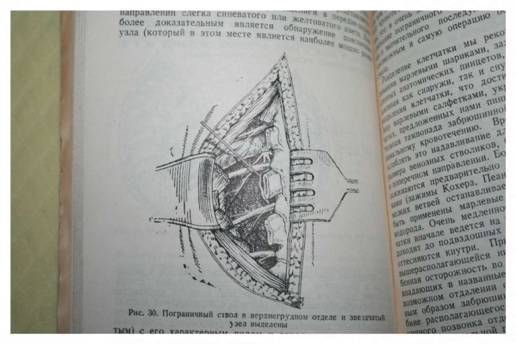 Бондарчук А.В. Каузалгия и ее хирургическое лечение.