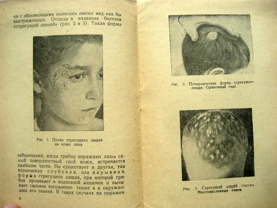 Ариевич А. Грибковые заболевания кожи. Стригущий лишай и парша