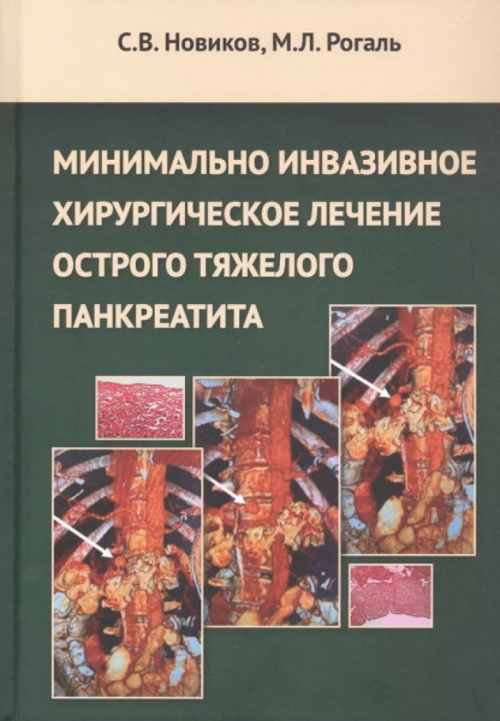 Новиков С.В., Рогаль М.Л. Минимально инвазивное хирургическое лечение острого тяжелого панкреатита.