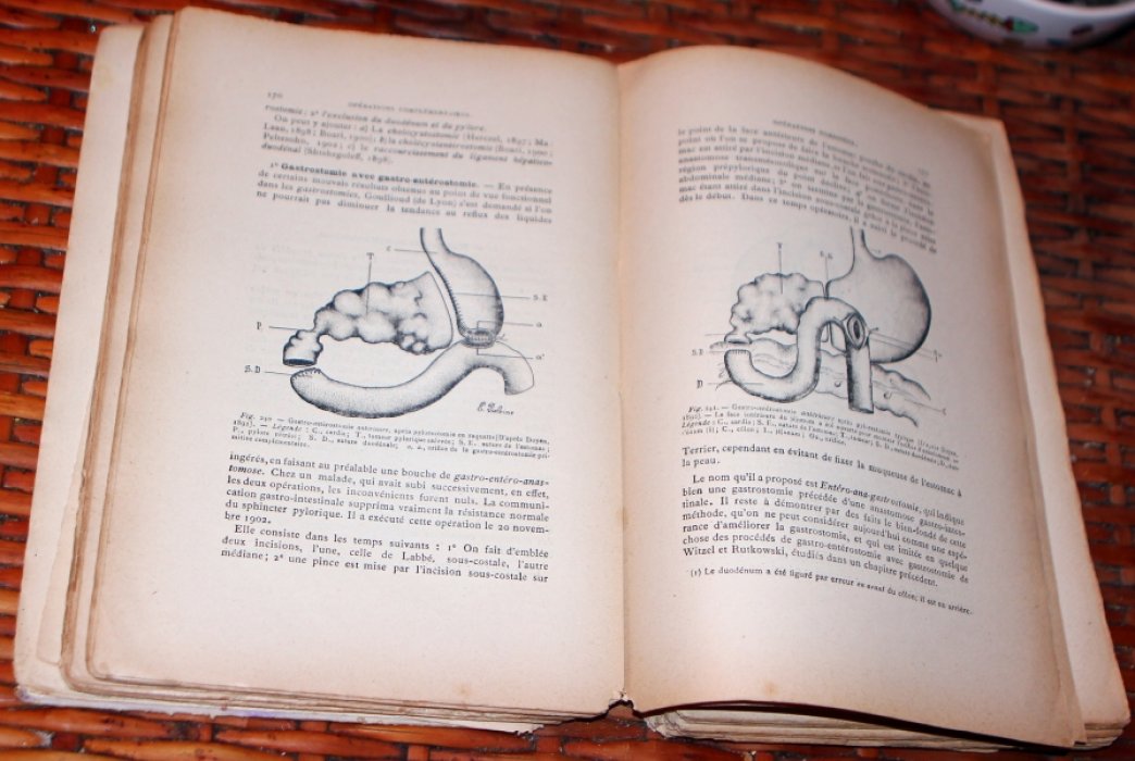 Prof. Monprofit Ambroise Jacques. La Gastro-Enterostomie. Histoire generale, metodes operatoires.